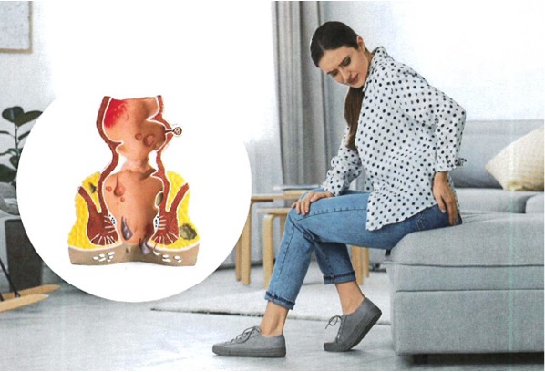 An anatomical model of the rectum with hemorrhoids, and a young woman sitting on the sofa, suffering from pain at home